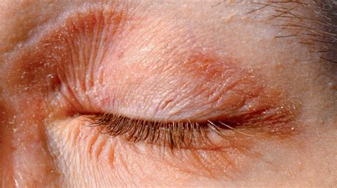 View 30 Red Dry Flaky Skin On Eyelids Hangulsiteesz