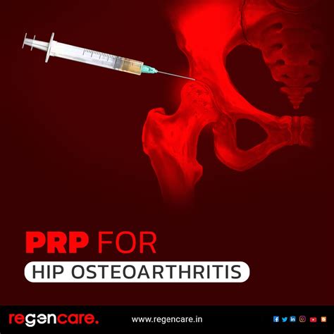 Prp Injection For Hip Osteoarthritis Orthogen Prp Injection