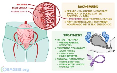 Postpartum Hemorrhage Management