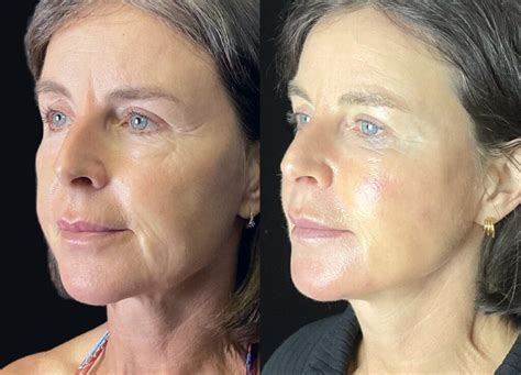 How Filler In Cheeks Can Lift Jowls Cheek Filler For Jowls The