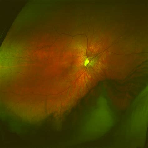 Why Are Dilated Retinal Exams Important For Diabetics Eyegotcha