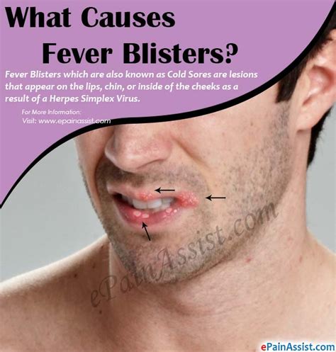 Causes Of Fever