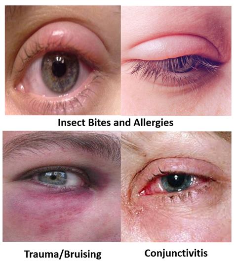 Swollen Eyelid Symptoms Treatment Pictures Causes You