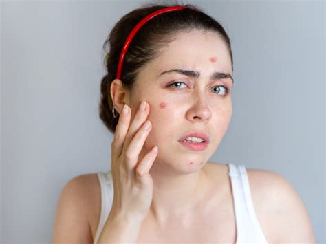 What Are The 7 Types Of Acne And How To Treat Them Onlymyhealth