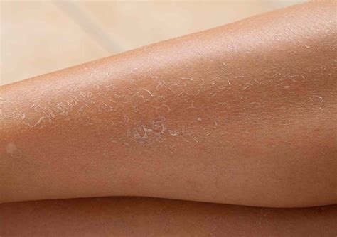 How To Get Rid Of Dry Skin On Legs — Moody Sisters Skincare