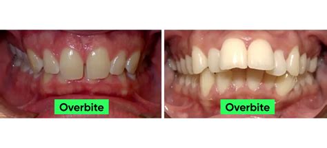 How Can Mewing Fix Overbite Ach