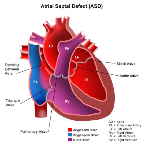 Congenital Heart Disease