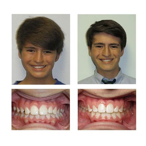 Braces Gallery Dr Toms Orthodontics In Greenville Sc