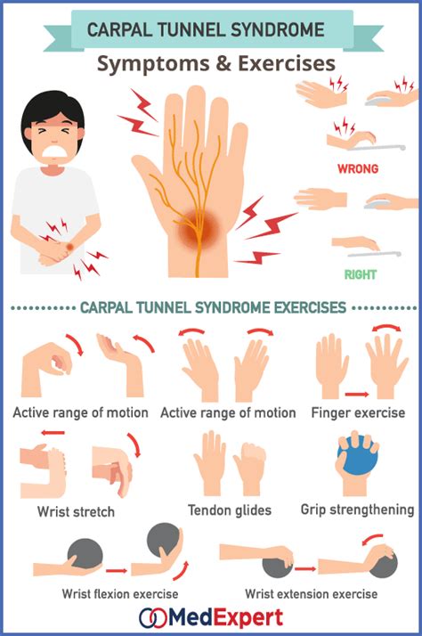 Carpal Tunnel Syndrome Med Expert Singapore