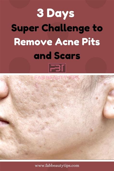 How To Heal Acne Scars Heal Info