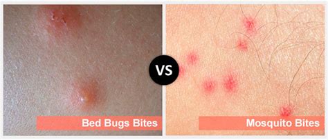 Mosquito And Bedbugs Bites Public Health