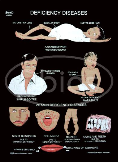 Deficiency Diseases Charts Manufacturer And Exporters From India Id