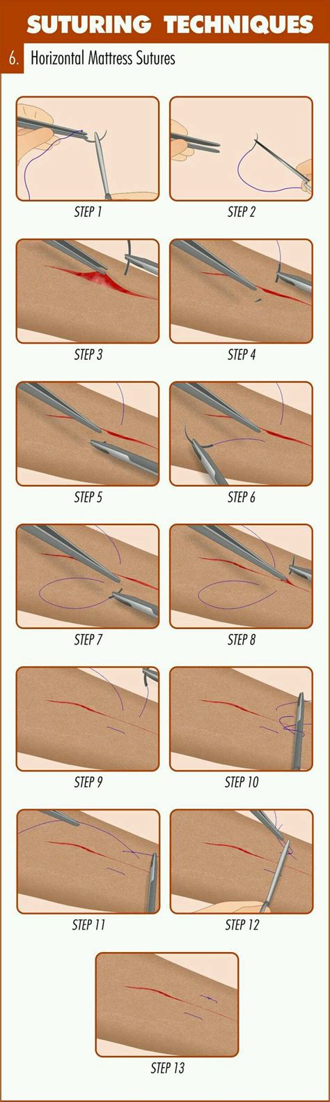 Pin By Linksoutside On Suture Methods Suture Techniques Emergency