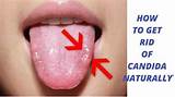 Photos of Tongue Fungus Home Remedies