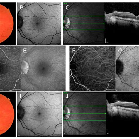 Multimodal Retinal Imaging Of A Case Of Acute Retinal Pigment