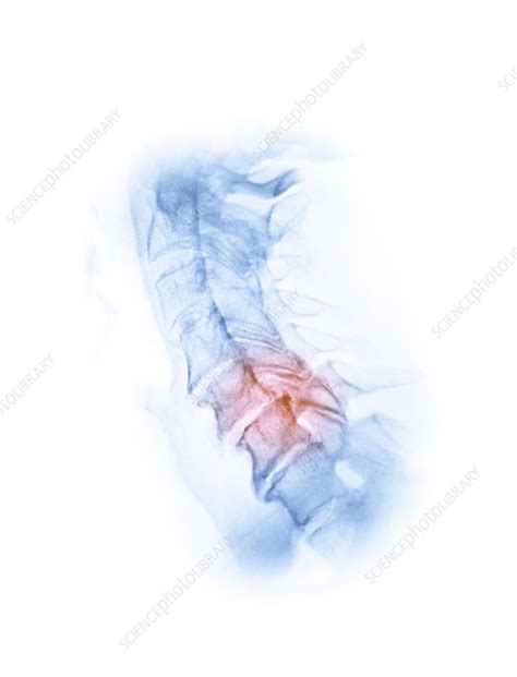 Osteoarthritis Of The Cervical Spine X Ray Stock Image F028 1842 Science Photo Library