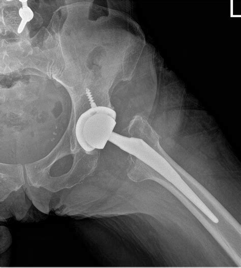Case Study Bilateral Total Hip Replacement 65 Yr Old Female