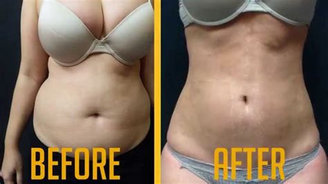 Vaser Liposuction Female Before After Video Advanced Lipo Centre