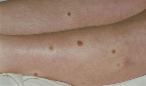 Skin Cancer Symptoms Purple Patches On The Skin Could Be A Sign Of