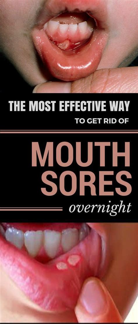 the most effective way to get rid of mouth sores overnight homeremedies fitness healthcare