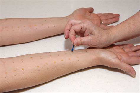 What Is An Allergy Skin Test Premier Allergy