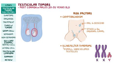 Testicular Tumors Pathology Review Video And Anatomy Osmosis
