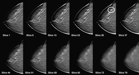 Digital Mammography An Update European Journal Of Radiology