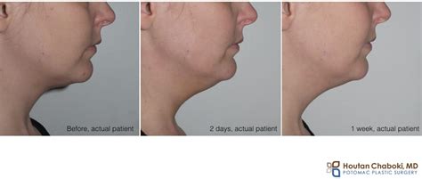 Recovery After Kybella Treatment Of Neck Fat Potomac Plastic Surgery