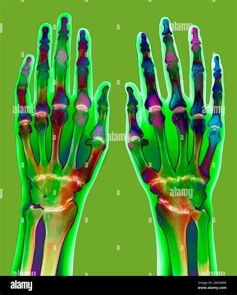 Arthritic Hands Coloured X Ray Of A Pair Of Hands Showing Rheumatoid