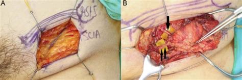 Orthotopic Transfer Of Vascularized Groin Lymph Node Flap In The