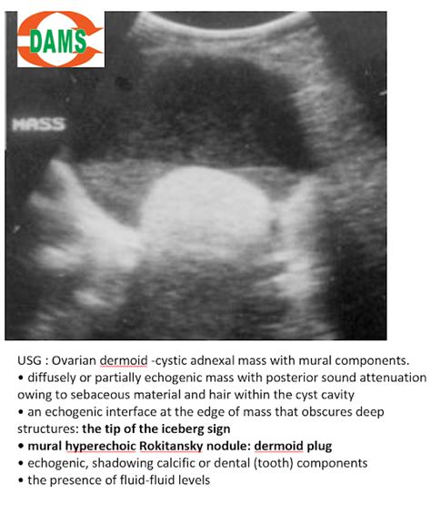 Ovarian Dermoid Ultrasound Teaching File Sumers Radiology Blog