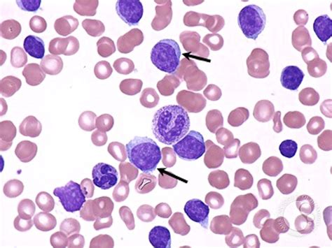 Chronic Lymphocytic Leukemia 2