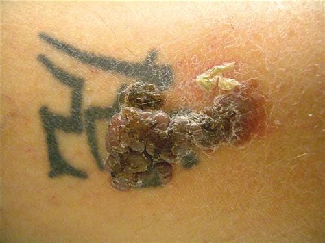 Follow Up In Patients With Localised Primary Cutaneous Melanoma The