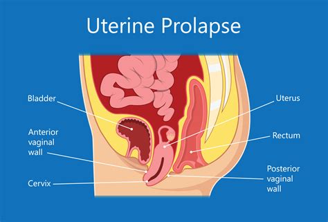 Uterine And Bladder Prolapse Guide Causes Symptoms And Treatment