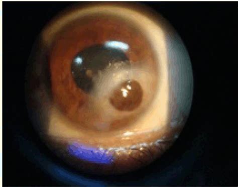 The cost of cataract surgery in the us for someone without medicare or private medical insurance has ranged from approximately $3,783 to $6,898 per eye use the services filter at top right of our doctor locator to find cataract surgeons in your area. adherent leucoma subsequent to a perforated corneal ulcer ...