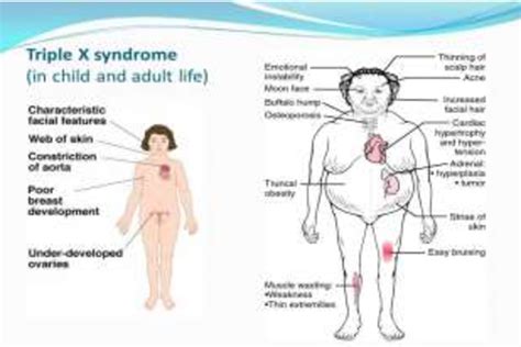 People With Triple X Syndrome