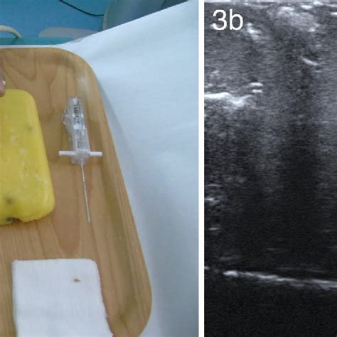 Using This Phantom To Undertake Ultrasound Guided Cyst Aspiration 3a