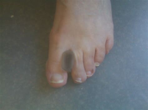 Foot And Ankle Problems By Dr Richard Blake Big Toe Length Differences And What It Means