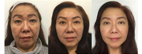 How To Prepare For A Facial Rejuvenation Treatment Dy Dermatology Center