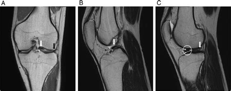 Mri Findings A Coronal T2 Weighted Fat Suppression Mr Image The