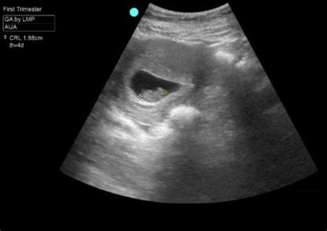How To Perform And Interpret A First Trimester Transabdominal Point Of