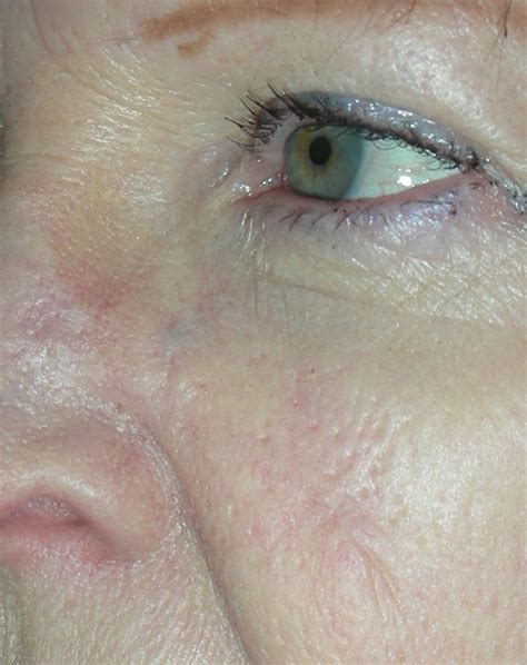 Skin Cancer Nose And Local Flap Repair Dr Damian Marucci Cosmetic