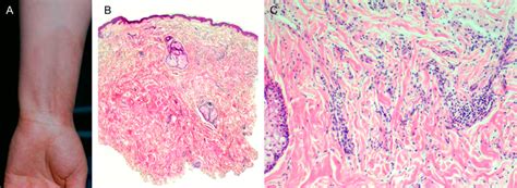 Diffuse Granuloma Annulare A Clinical Picture B Histologically A Download Scientific