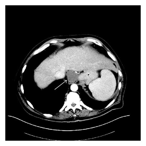 A Intravenous Contrast Enhanced Axial Ct Scan Of The Abdomen