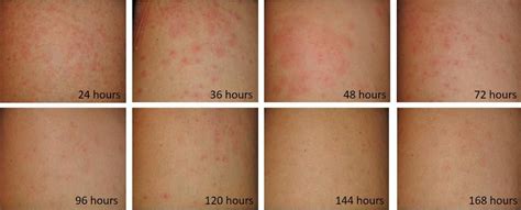 Eny 2038in1200 Swimmers Itch Cercarial Dermatitis