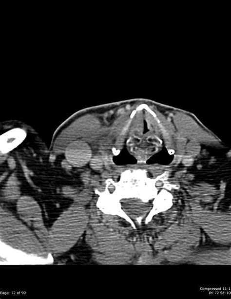 Left Vocal Cord Lesion Squamous Cell Carcinoma Radiology Case