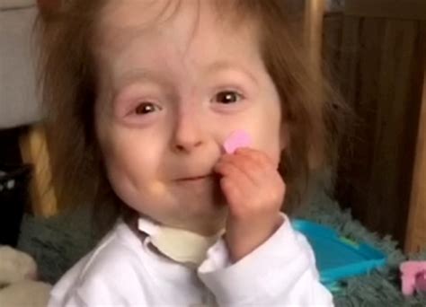 Watch Little Girl With A Rare Benjamin Button Disease Becomes Tik