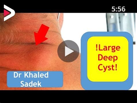 Sebaceous Cyst Removal London Cyst Clinic Dr Khaled Sadek LipomaCyst