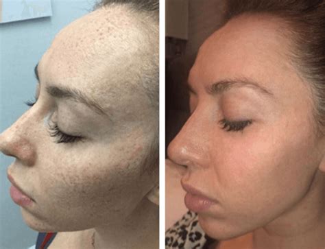 Learn microneedling online become a professional microneedling therapist or simply learn how to perform microneedling. Shedding Microneedling - Side effects aftercare the final ...