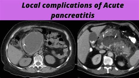 Local Complications Of Acute Pancreatitis Youtube